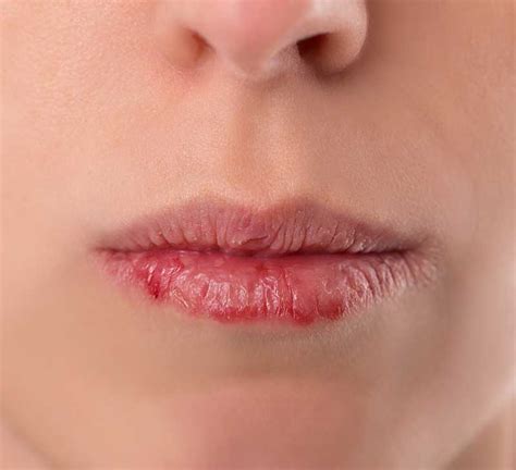 Does lip cancer tingle?