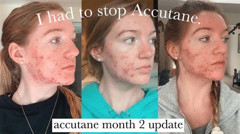 Does liver heal after Accutane?