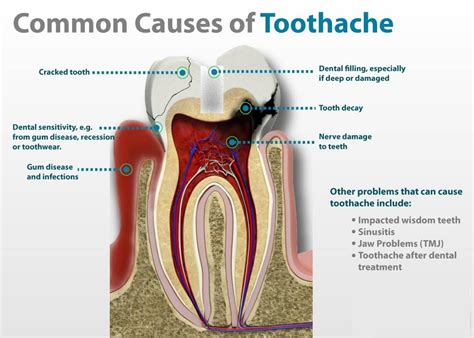 Does lying down help toothache?