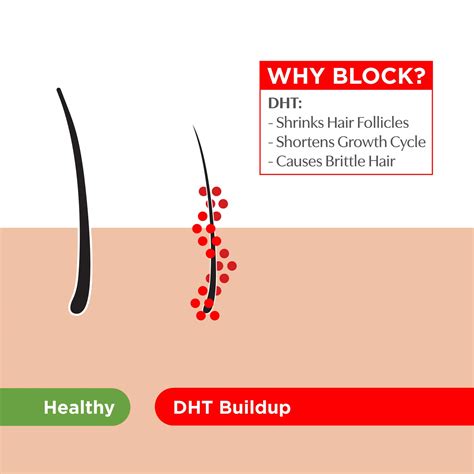 Does magnesium block DHT?