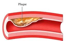 Does magnesium dissolve arterial plaque?