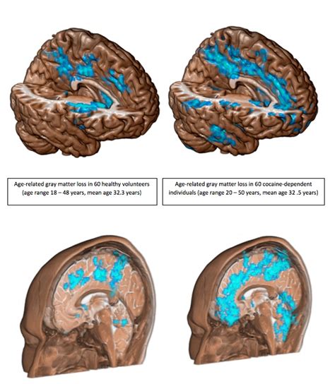 Does mania hurt the brain?