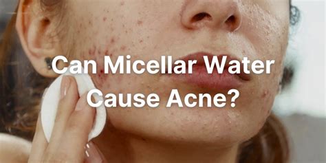 Does micellar water cause cystic acne?