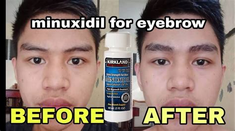 Does minoxidil work after 40?