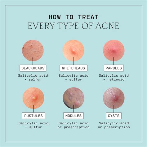 Does most acne go away?