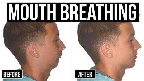 Does mouth breathing cause double chin?