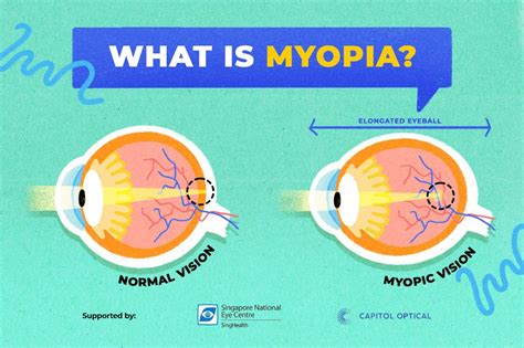 Does myopia stop 18?