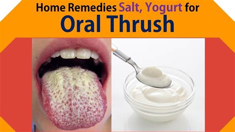 Does natural yogurt help thrush?