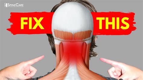Does neck pain go away naturally?