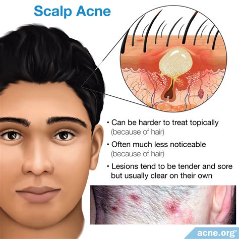 Does oily hair make acne worse?