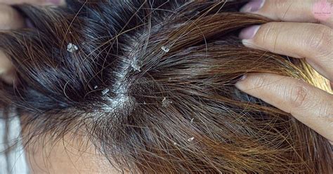 Does oily scalp cause hairloss?
