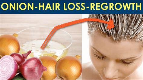 Does onion regrow hair?