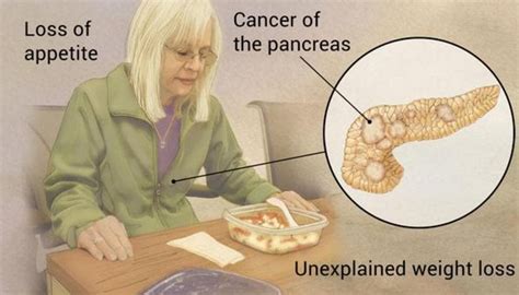 Does pancreatitis shorten life expectancy?