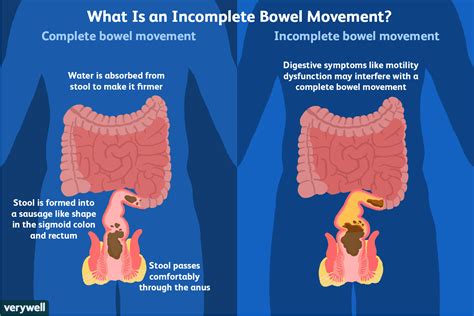 Does passing gas mean your bowels are moving?