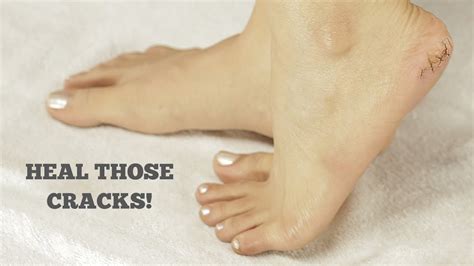 Does pedicure remove cracked heels?