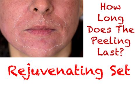 Does peeling skin mean healing?
