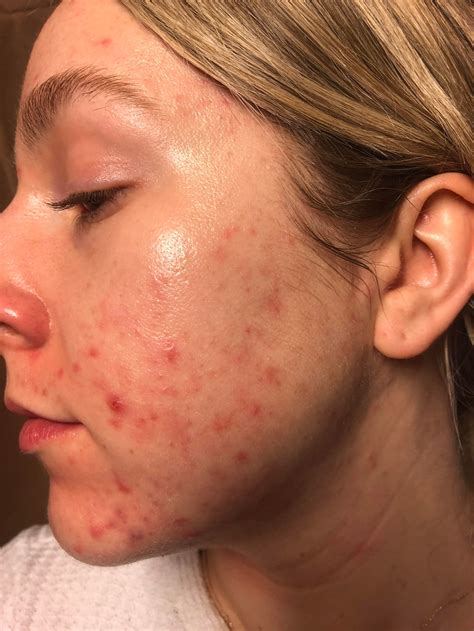 Does picking acne spread it?