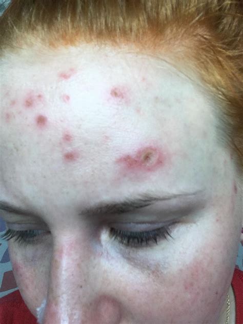 Does picking back acne make it worse?