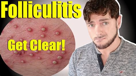 Does picking folliculitis make it worse?