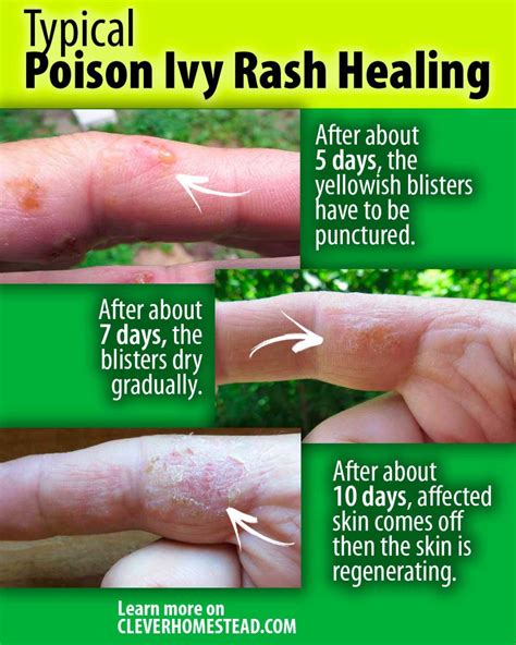 Does poison ivy rash turn purple when healing?