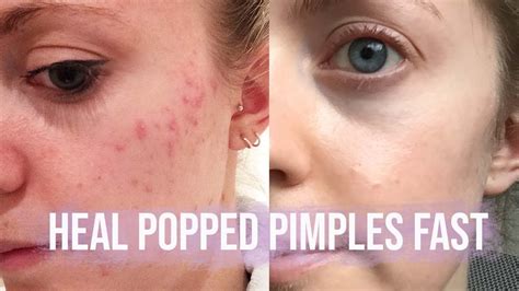Does popping a pimple help it heal faster?
