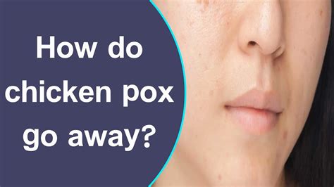 Does pox go away on its own?