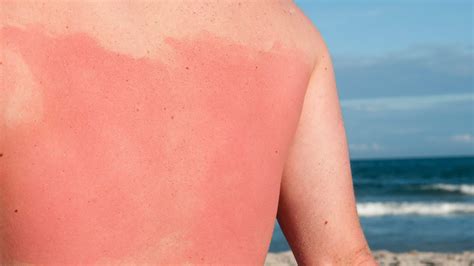 Does putting sunscreen on a burn help?