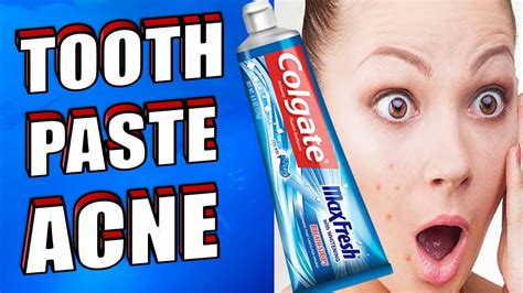 Does putting toothpaste on acne help?