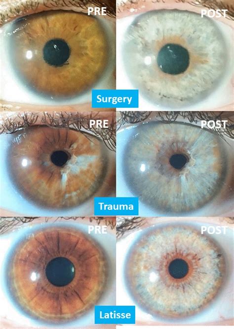 Does releasing trauma change your eye color?