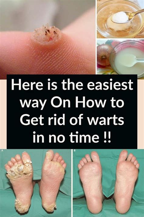 Does removing a wart leave a hole?