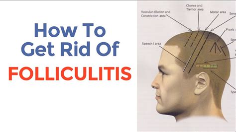 Does removing hair cure folliculitis?