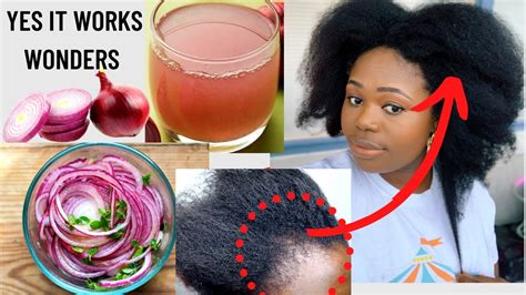 Does rubbing onion help hair growth?
