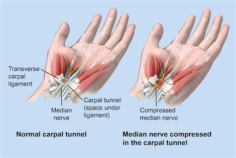 Does rubbing your wrist help carpal tunnel?