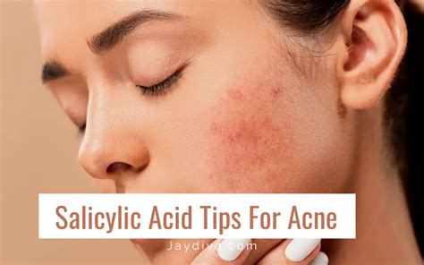 Does salicylic acid remove fungal acne?