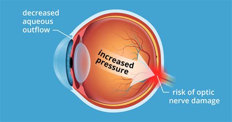 Does salt cause high eye pressure?