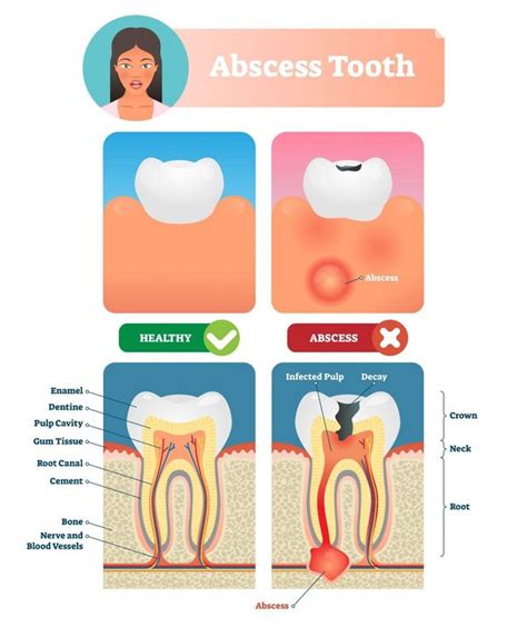 Does salt draw out infection in tooth?