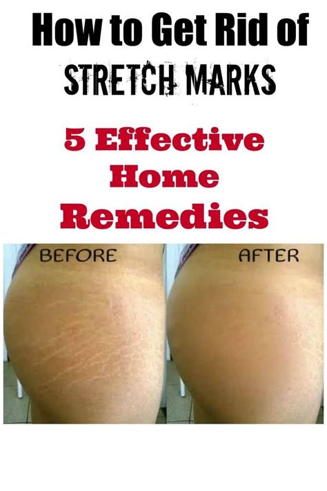 Does salt remove stretch marks?