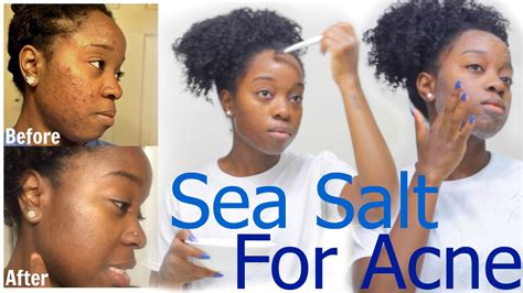 Does salt water clear acne?