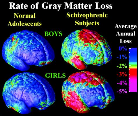 Does schizophrenia age the brain?