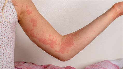 Does scratching make hives worse?