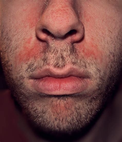 Does seborrheic dermatitis burn on face?