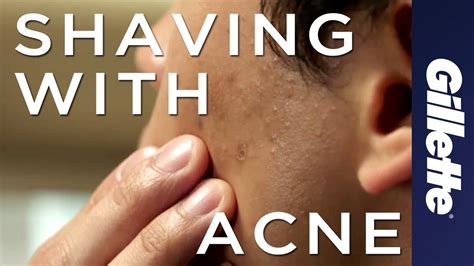 Does shaving help acne or make it worse?