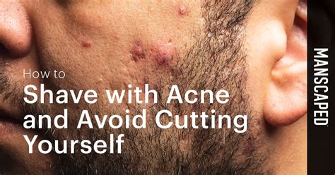 Does shaving over acne cause scars?