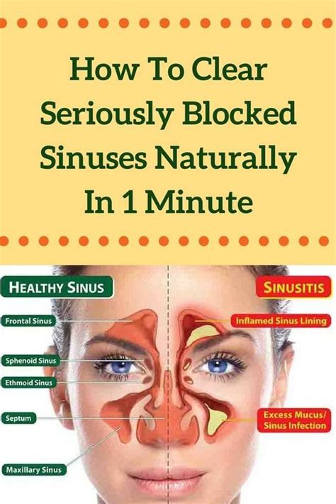 Does sinus go away naturally?