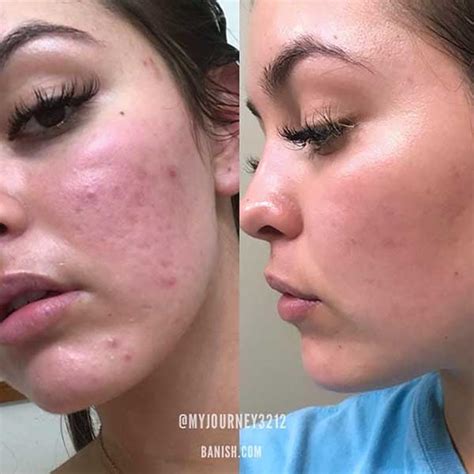 Does skin go back to normal after acne?