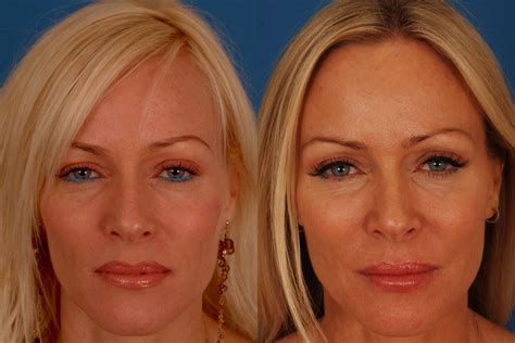 Does skin look better after Botox?