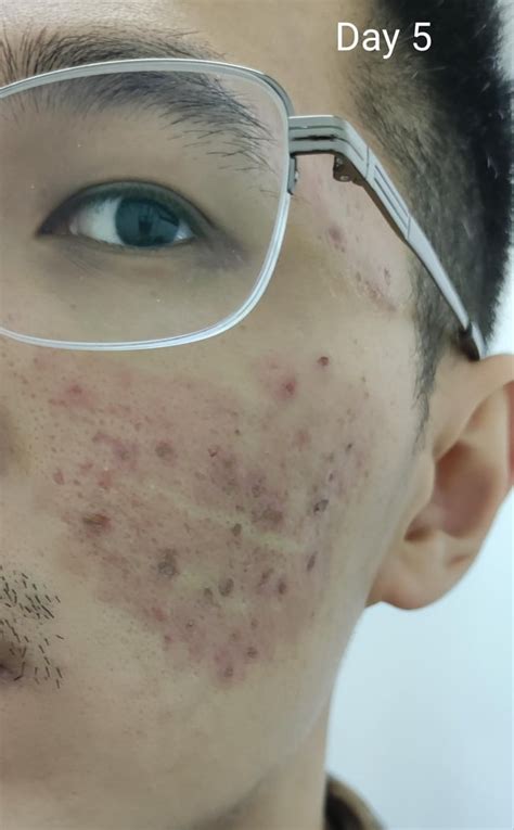 Does skin look worse after laser?