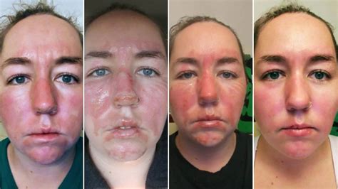 Does skin peel after second-degree burn?