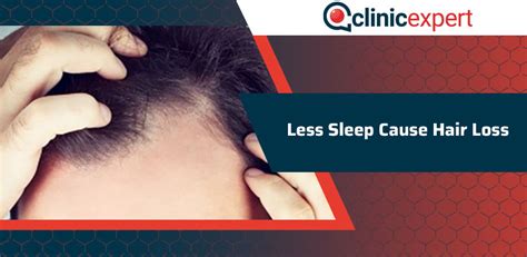 Does sleeping late cause hair loss?