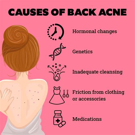 Does sleeping on back cause acne?